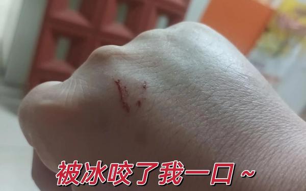 寒冬之咬 冬天被咬大包